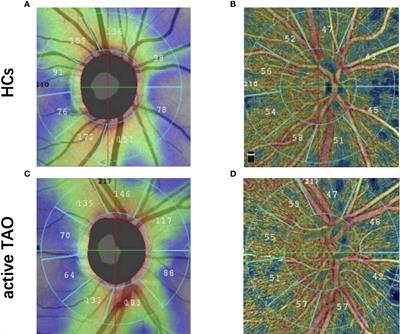 Alterations in Spontaneous Neuronal Activity and Microvascular Density of the Optic Nerve Head in Active Thyroid-Associated Ophthalmopathy